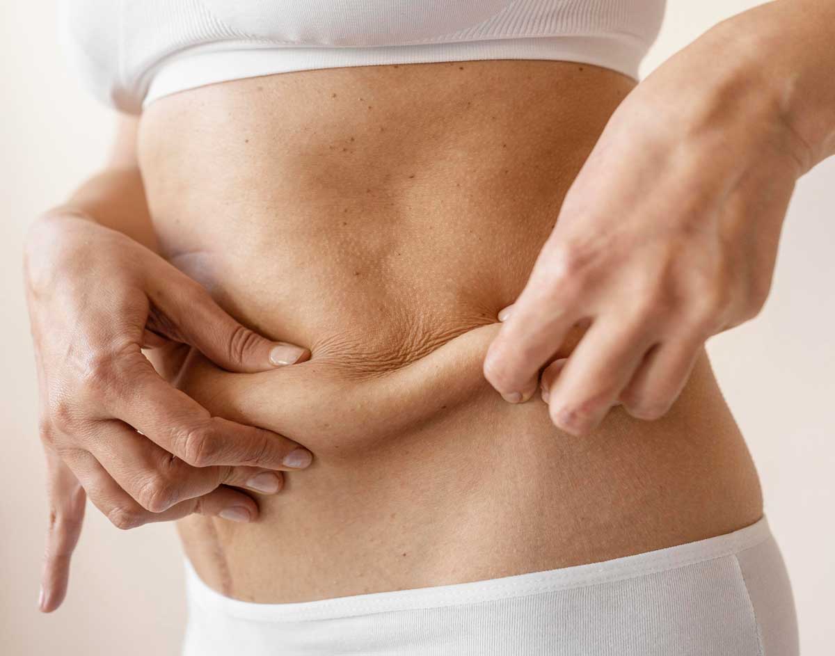 tratamento-gordura-localizada-no-barreiro-bh-clínica-de-estética